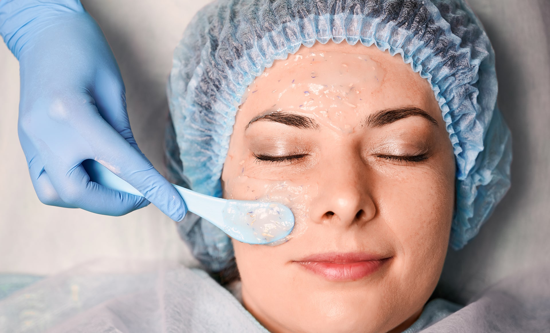 chemical peeling clear skin 01