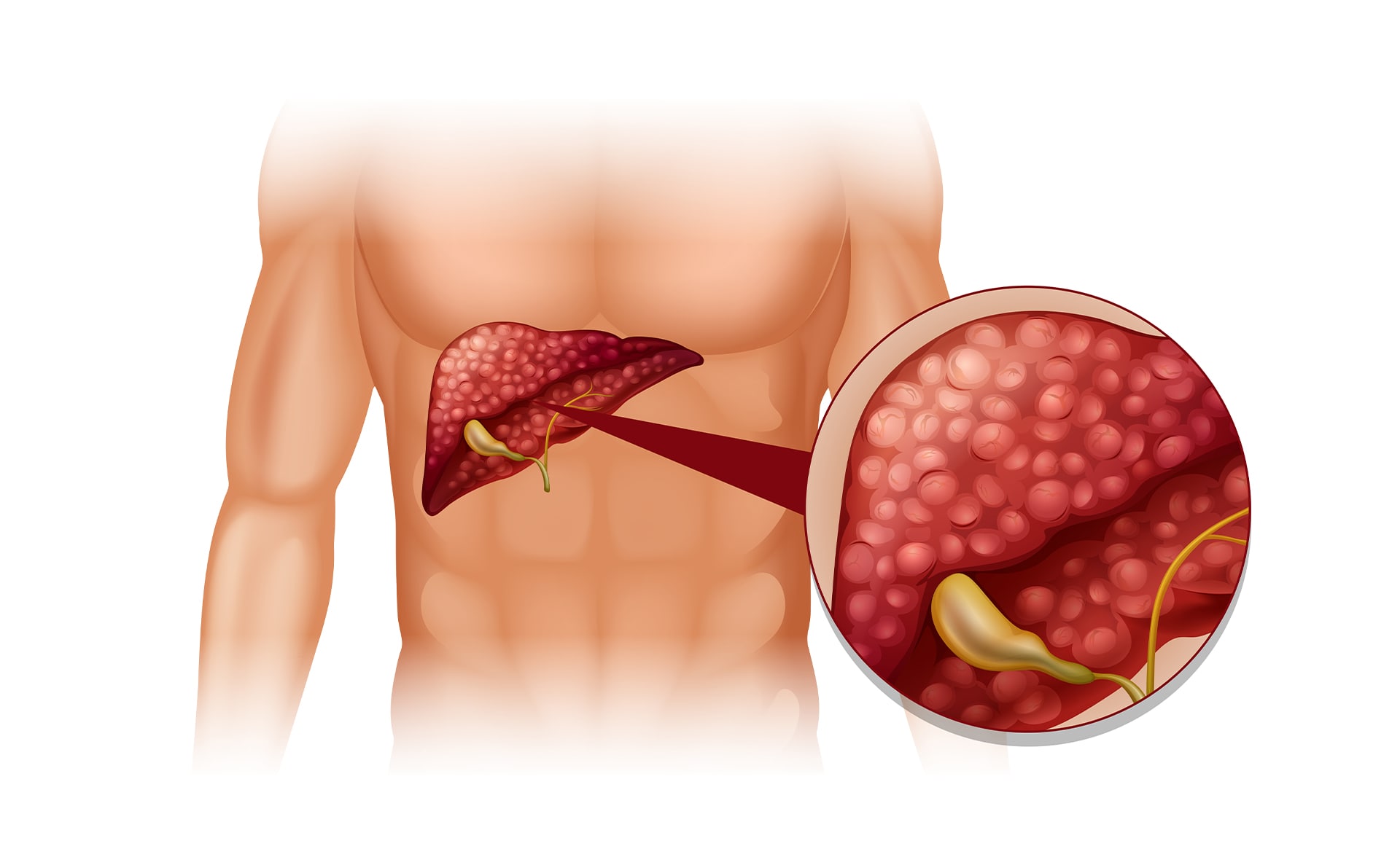 liver cirrhosis complete guide 01